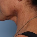Facelift Before & After Patient #2710