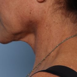Facelift Before & After Patient #2710