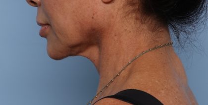 Facelift Before & After Patient #2710