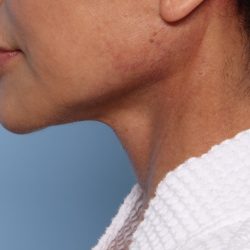 Facelift Before & After Patient #2710