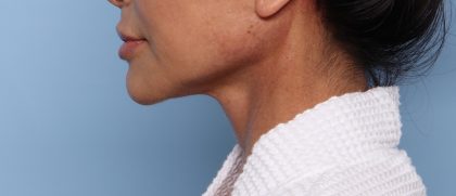 Facelift Before & After Patient #2710