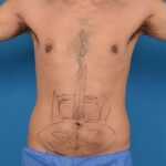 Abdominal Etching Before & After Patient #1288