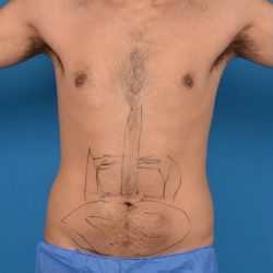 Abdominal Etching Before & After Patient #1288