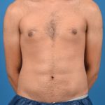Abdominal Etching Before & After Patient #1288