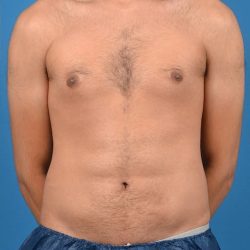 Abdominal Etching Before & After Patient #1288