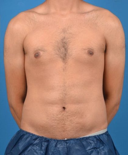 Abdominal Etching Before & After Patient #1288