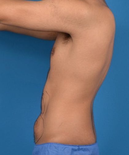 Abdominal Etching Before & After Patient #1288
