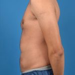 Abdominal Etching Before & After Patient #1288