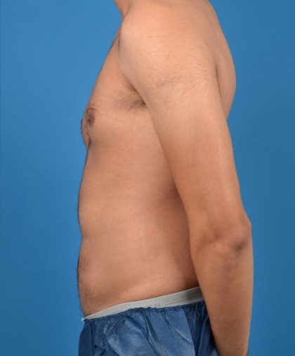 Abdominal Etching Before & After Patient #1288