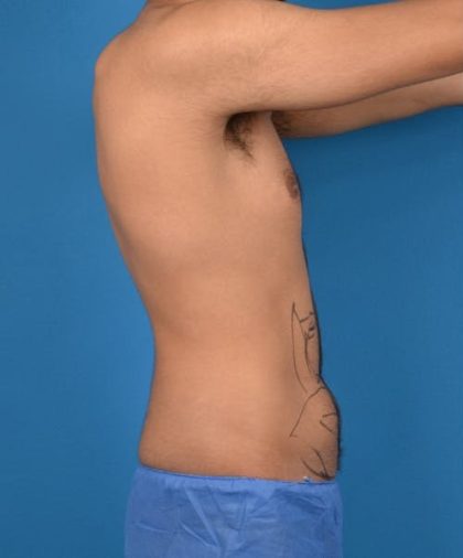 Abdominal Etching Before & After Patient #1288