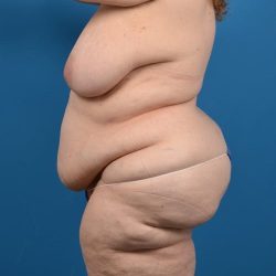 Abdominoplasty Before & After Patient #1279