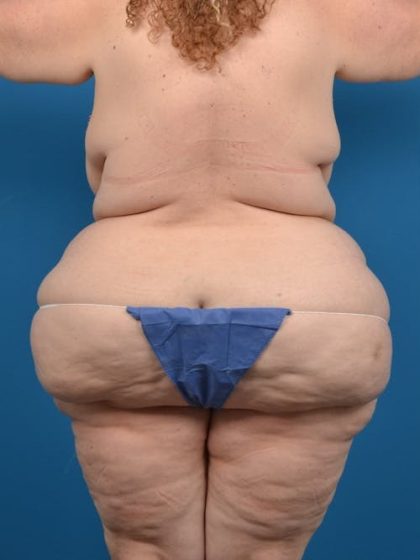 Abdominoplasty Before & After Patient #1279