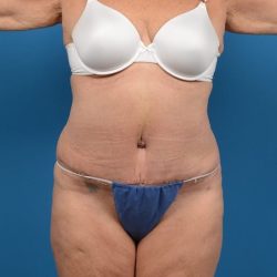 Abdominoplasty Before & After Patient #1280