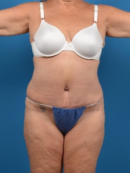 Abdominoplasty Before & After Patient #1280