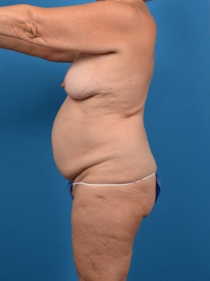 Abdominoplasty Before & After Patient #1280