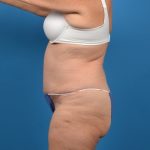 Abdominoplasty Before & After Patient #1280