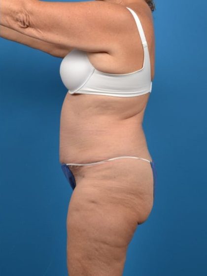 Abdominoplasty Before & After Patient #1280