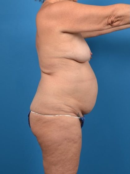 Abdominoplasty Before & After Patient #1280