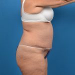 Abdominoplasty Before & After Patient #1280