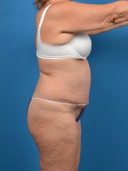 Abdominoplasty Before & After Patient #1280