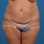 Abdominoplasty Before & After Patient #1278