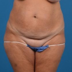 Abdominoplasty Before & After Patient #1278