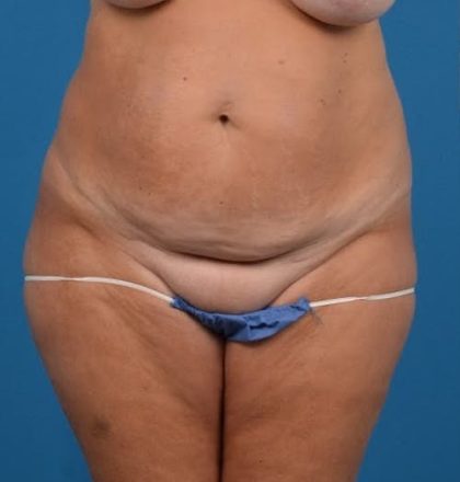 Abdominoplasty Before & After Patient #1278