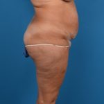 Abdominoplasty Before & After Patient #1278