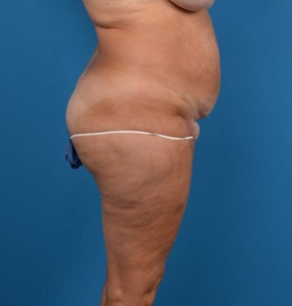 Abdominoplasty Before & After Patient #1278