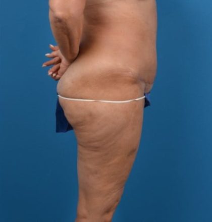 Abdominoplasty Before & After Patient #1278