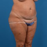 Abdominoplasty Before & After Patient #1278