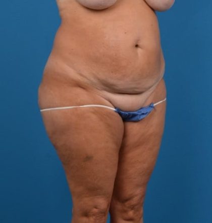 Abdominoplasty Before & After Patient #1278