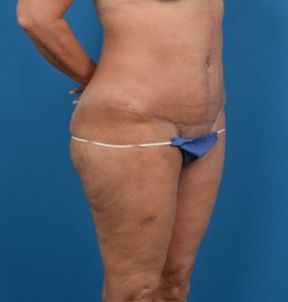 Abdominoplasty Before & After Patient #1278