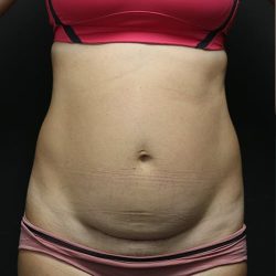 Abdominoplasty Before & After Patient #1269