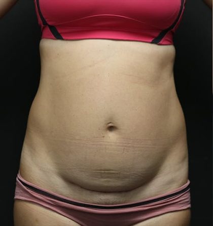 Abdominoplasty Before & After Patient #1269