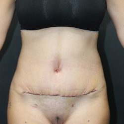 Abdominoplasty Before & After Patient #1269