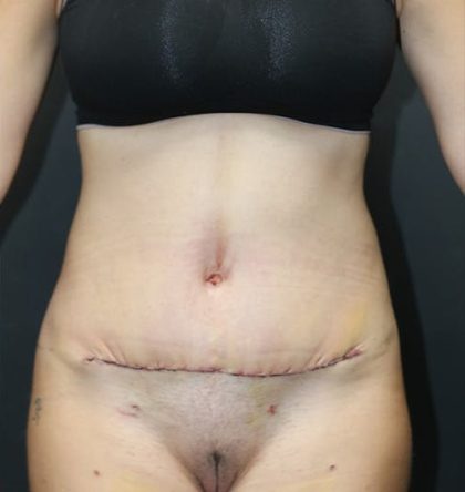 Abdominoplasty Before & After Patient #1269