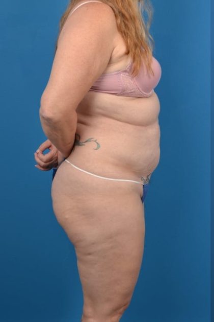 Abdominoplasty Before & After Patient #1276