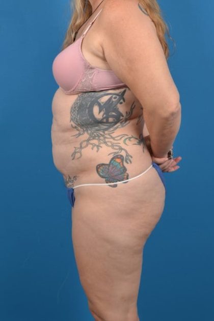 Abdominoplasty Before & After Patient #1276