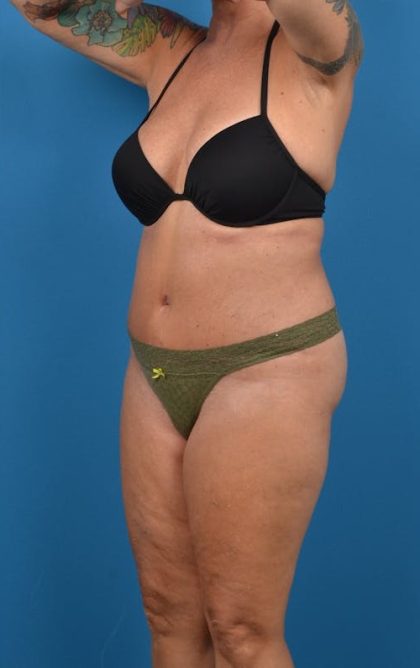 Abdominoplasty Before & After Patient #1275