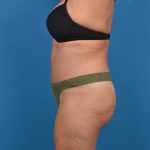 Abdominoplasty Before & After Patient #1275