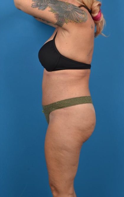 Abdominoplasty Before & After Patient #1275