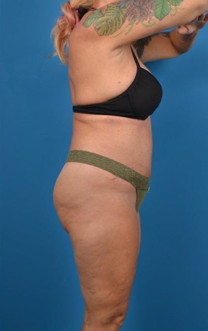 Abdominoplasty Before & After Patient #1275