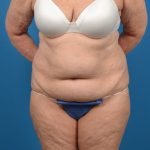 Abdominoplasty Before & After Patient #1274