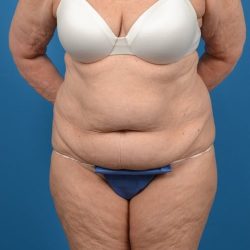 Abdominoplasty Before & After Patient #1274
