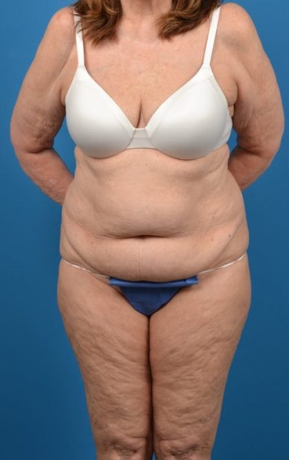 Abdominoplasty Before & After Patient #1274