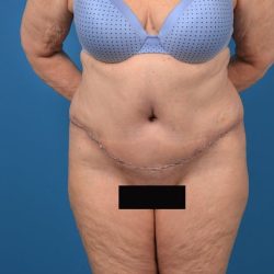 Abdominoplasty Before & After Patient #1274