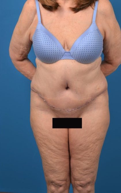 Abdominoplasty Before & After Patient #1274