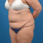 Abdominoplasty Before & After Patient #1274