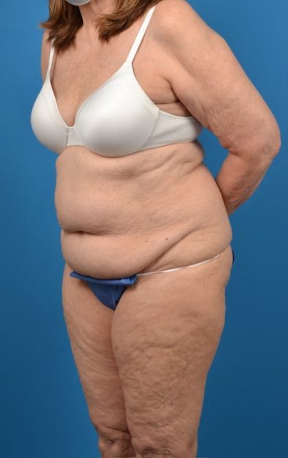 Abdominoplasty Before & After Patient #1274